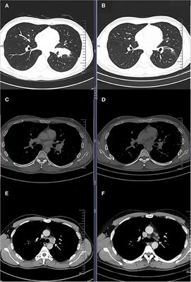 Neoadjuvant Four-Drug Combination Therapy for NSCLC With EGFR Mutation Avoiding Total Pneumonectomy